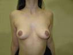 Женская грудь деформация
