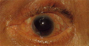 Иридоциклит и вторичная глаукома. Цилиарная инъекция
