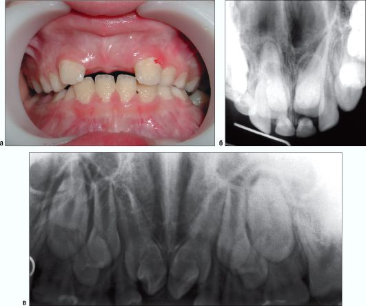 СКЗ во фронтальном отделе верхней челюсти ретенция зубов 11 и 21