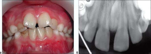 Ребенок 10 лет. СКЗ во фронтальном отделе верхней челюсти между зубами 11 и 21
