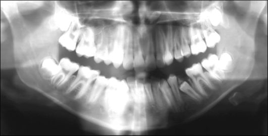 СКЗ в области дна левого носового хода и в области зубов 22 и 23
