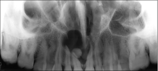 Фолликулярная киста во фронтальном отделе верхней челюсти от ретенированного СКЗ в области зубов 11, 21