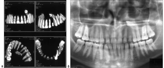 Ребенок 15 лет. Ретенция зуба 23: а - трехмерная компьютерная томограмма верхней челюсти