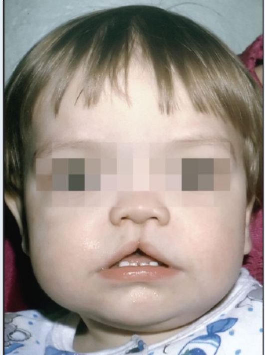 Ребенок 2 лет. Синдром фронто-назальной дисплазии