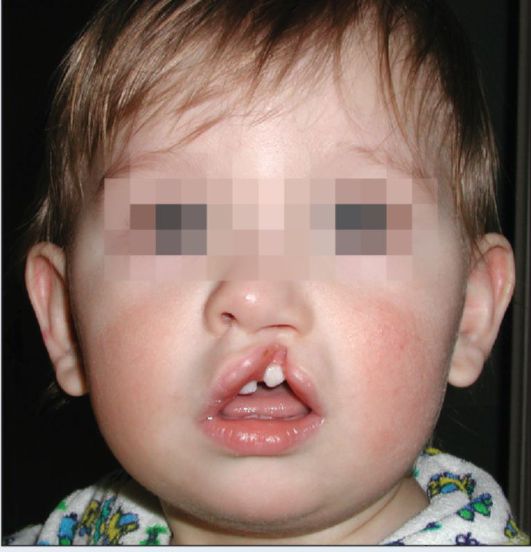 Врожденная неполная левосторонняя расщелина верхней губы с деформацией кожно-хрящевого отдела носа