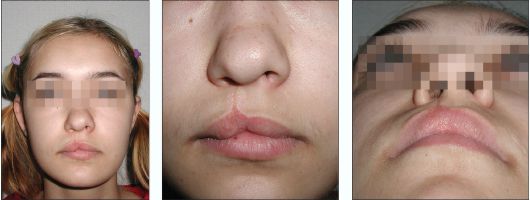 Остаточная деформация кожно-хрящевого отдела носа и вторичная деформация верхней губы