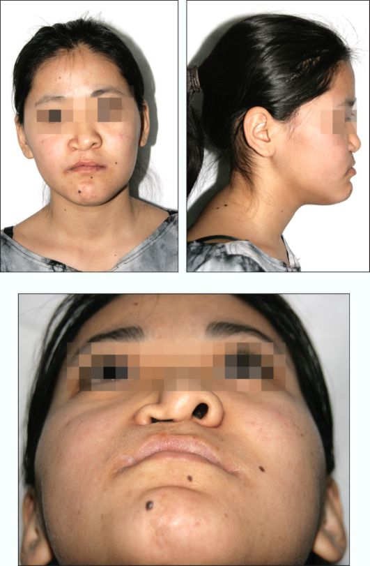 Ребенок 15 лет. Остаточная и вторичная деформация кожно-хрящевого отдела носа и рубцовая деформация верхней губы