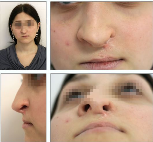 Ребенок 17 лет. Остаточная и вторичная деформация кожно-хрящевого отдела носа и верхней губы