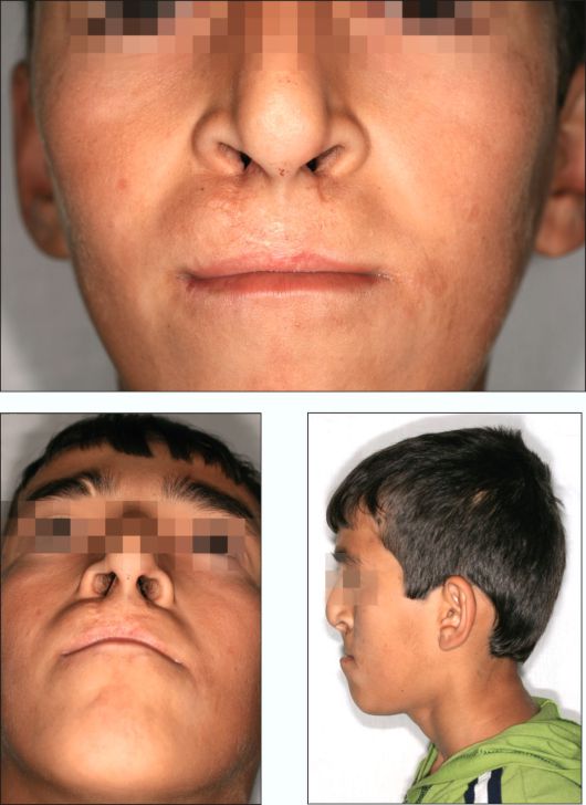 Ребенок 14 лет. Вторичная и остаточная деформация носа и верхней губы