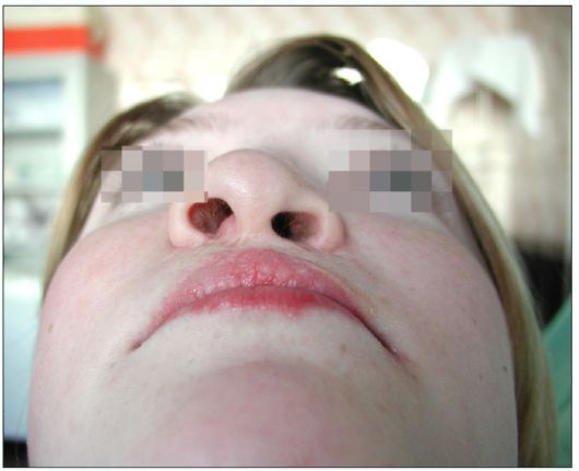 Ребенок 16 лет. Вторичная и остаточная деформация носа и губы