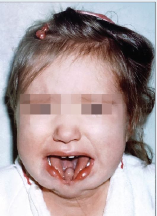 Ребенок 1 года. Срединная расщелина нижней губы