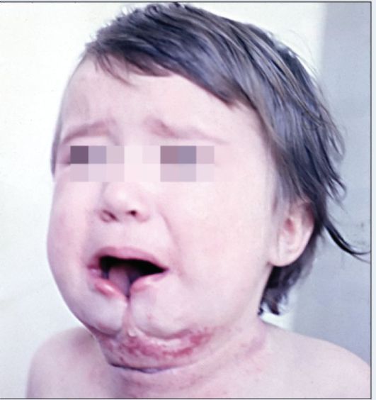 Ребенок 1 года. Срединная расщелина нижней губы