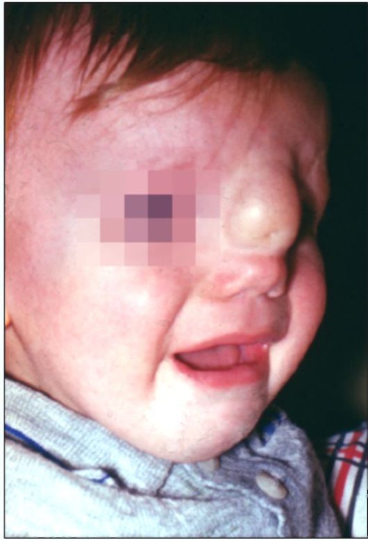 Ребенок 6 месяцев. Дермоидная киста корня носа