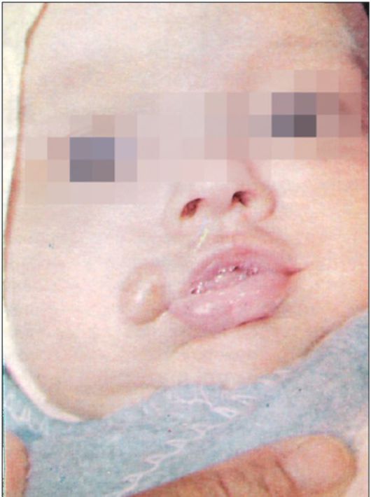 Ребенок 2 месяцев. Дермоидная киста угла рта