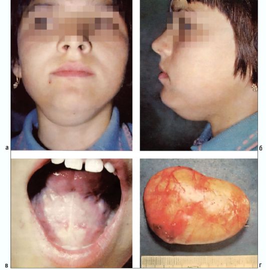 Ребенок 9 лет. Эпидермоидная киста дна полости рта