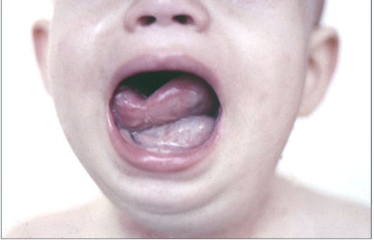 Ребенок 7 месяцев. Эпидермоидная киста дна полости рта