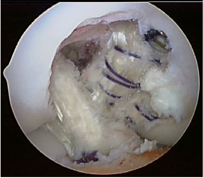 Двухпучковая реконструкция задней крестообразной связки аллотрансплантатом ахиллова сухожилия