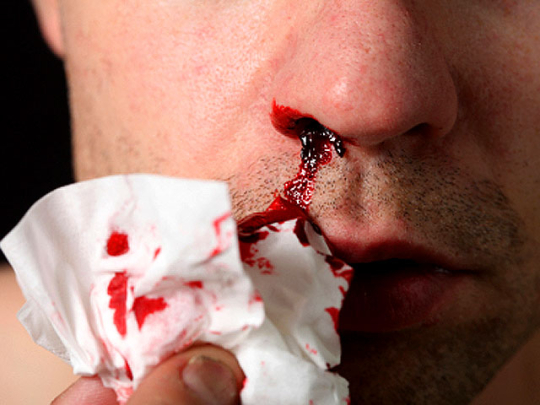 Носовое кровотечение при лучевой болезни