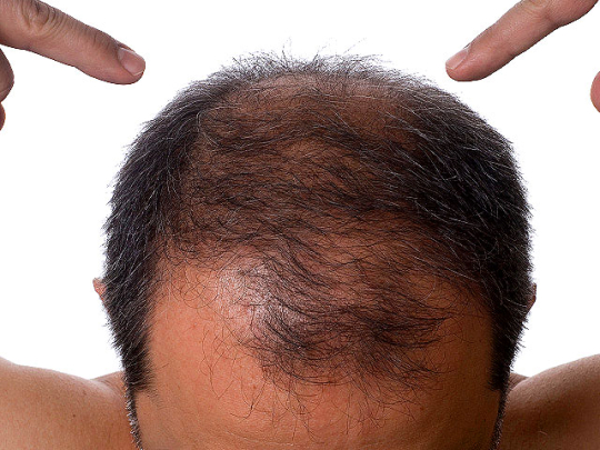 Потеря волос при лучевой болезни