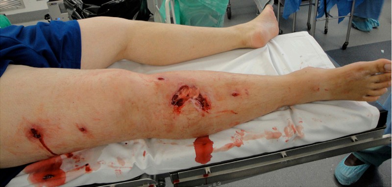 Открытый вывих в коленном суставе со значительным повреждением покровных тканей