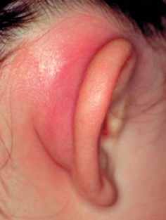 мастоидит ушной раковины