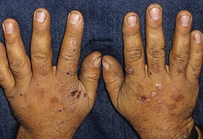 Склеровитилигинозная форма поздней кожной порфирии