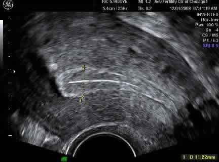 УЗИ матки с нормальным трехслойным эндометрием толщиной 11.2 mm