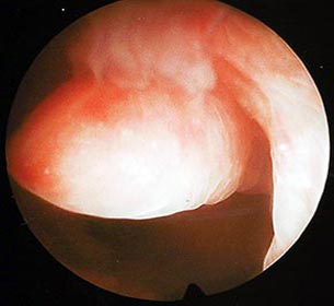 Гистероскопическая картина полипа эндометрия
